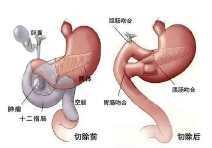 胆管空肠吻合图片